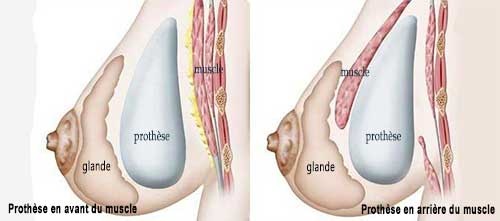 implants mammaires tunisie